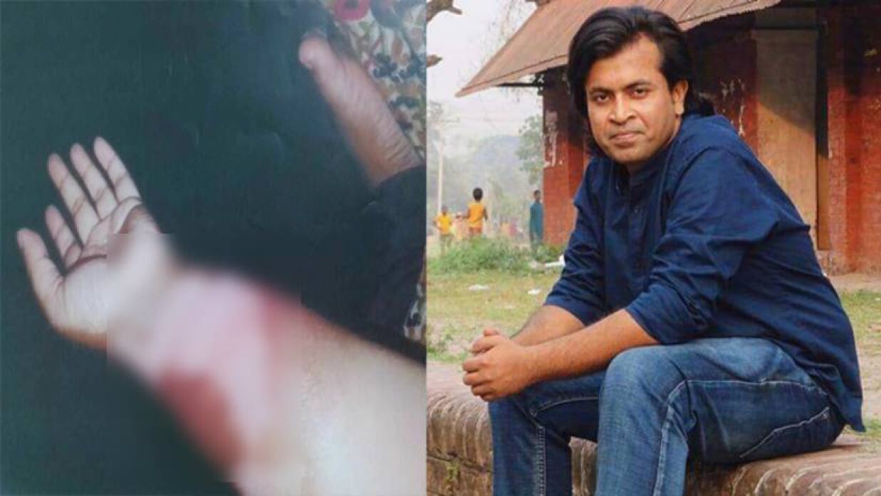 ভুক্তভোগীর ঝলসে যাওয়া হাত (বামে) ও চবি সংগীত বিভাগের সহকারী অধ্যাপক অনাবিল ইহসান (ডানে)।