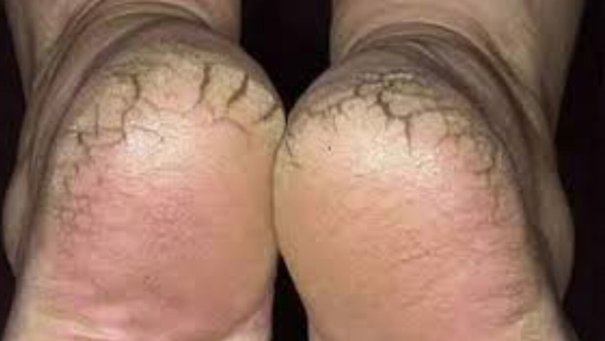 শীতে পা ফাটার সমস্যা নিয়ে চিন্তিত, মুক্তি পেতে যা করবেন