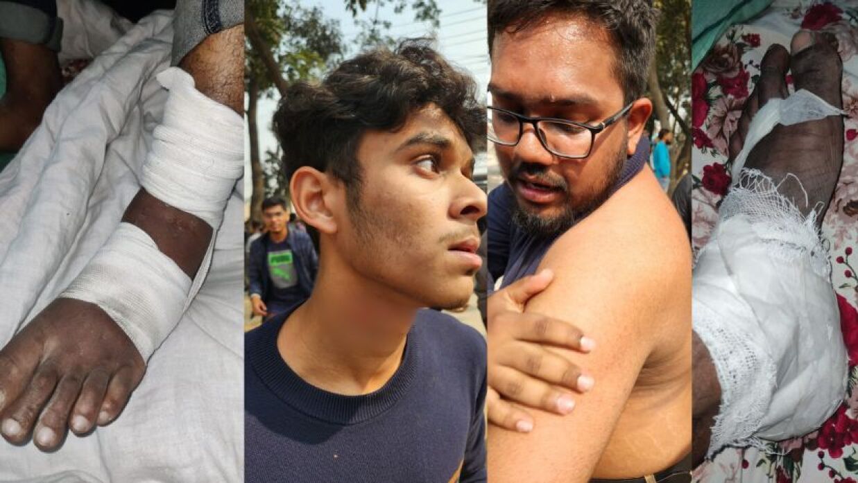 ‘অন ক্যাম্পাস অনার্স প্রোগ্রাম’ চালুর দাবিতে অবরোধে আহত শিক্ষার্থীরা