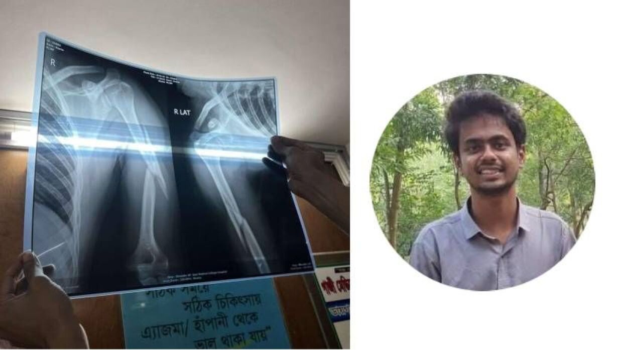 এক্স রে রিপোর্ট ও আহত শিক্ষার্থী শিক্ষার্থী সাজেদুল ইসলাম সৌরভ