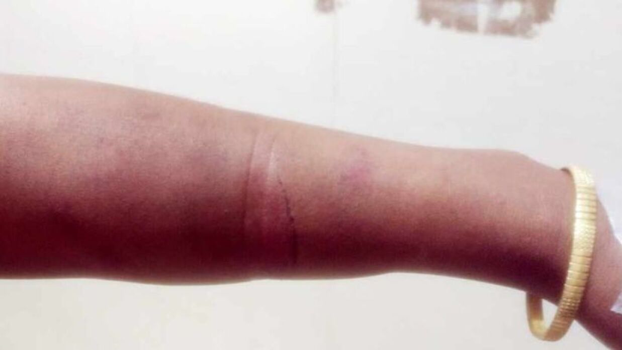 মারধরে নারীর হাতে জখমের চিহ্ন