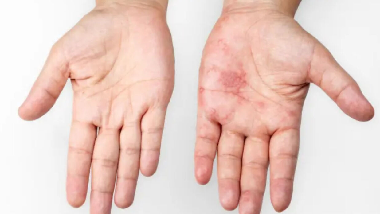 খোস-পাঁচড়া একটি ছোঁয়াচে রোগ